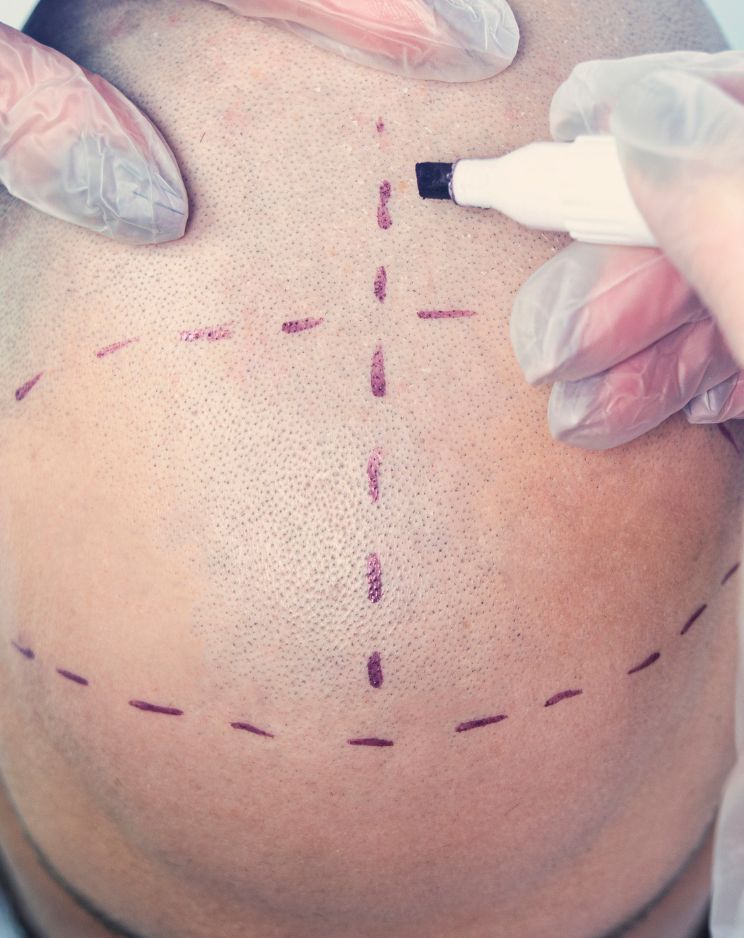 Bio FUE Hair Transplant