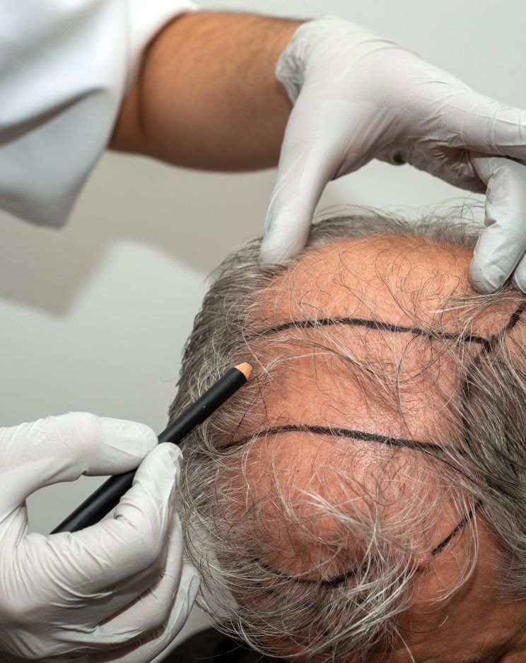 Biofibre Hair Transplant