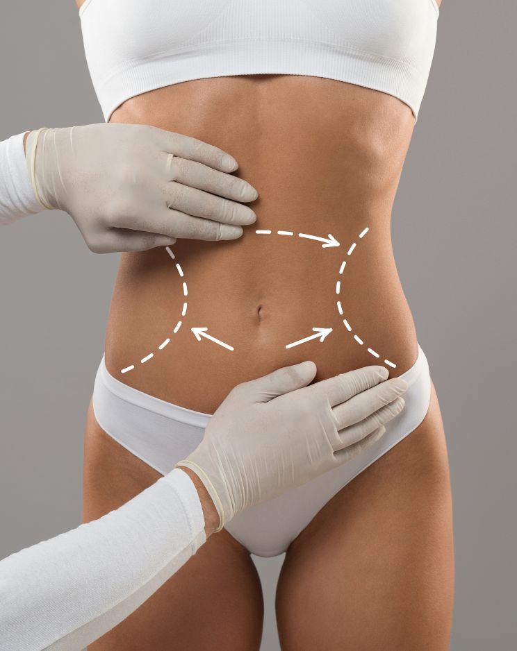 Body Recontouring