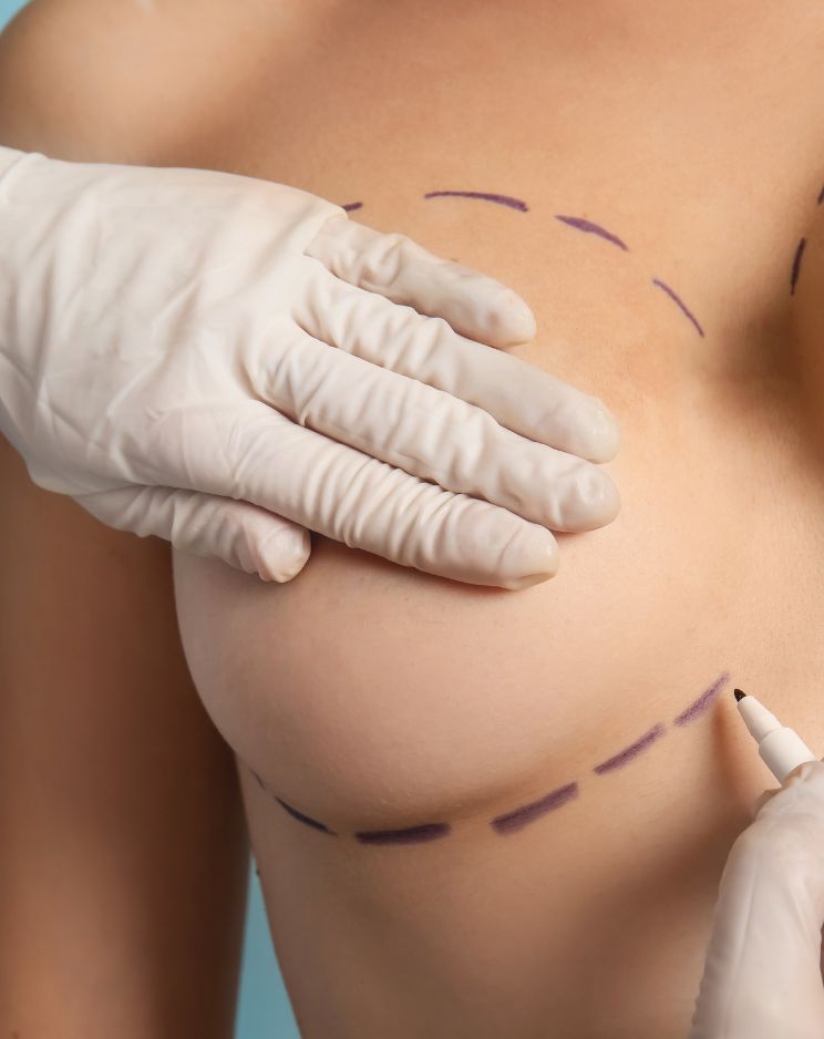 Breast Reconstruction