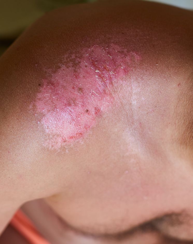 Burn and Cancer Treatemnt