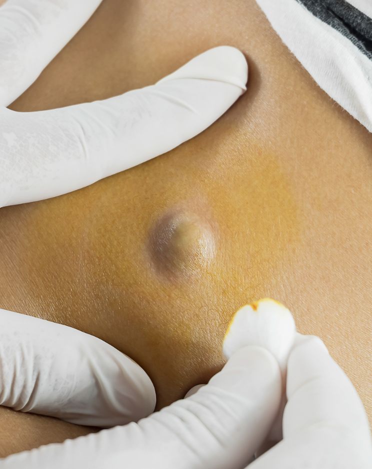 Cyst and Tumour Removal
