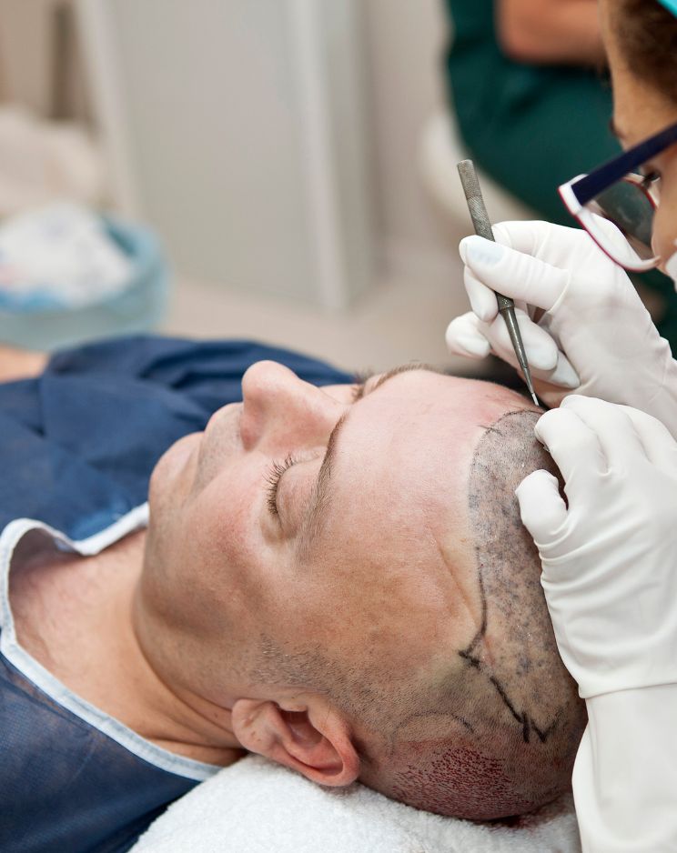 DHT Hair Transplant