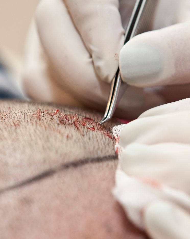 FUE Hair Transplant