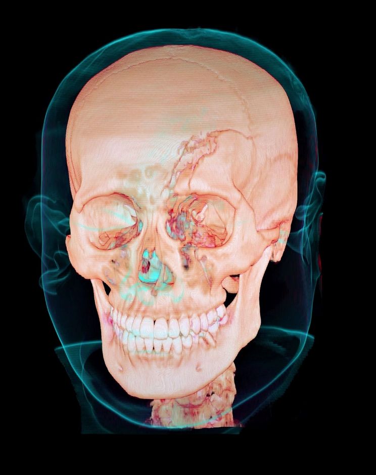 Fractures of Facial Bones