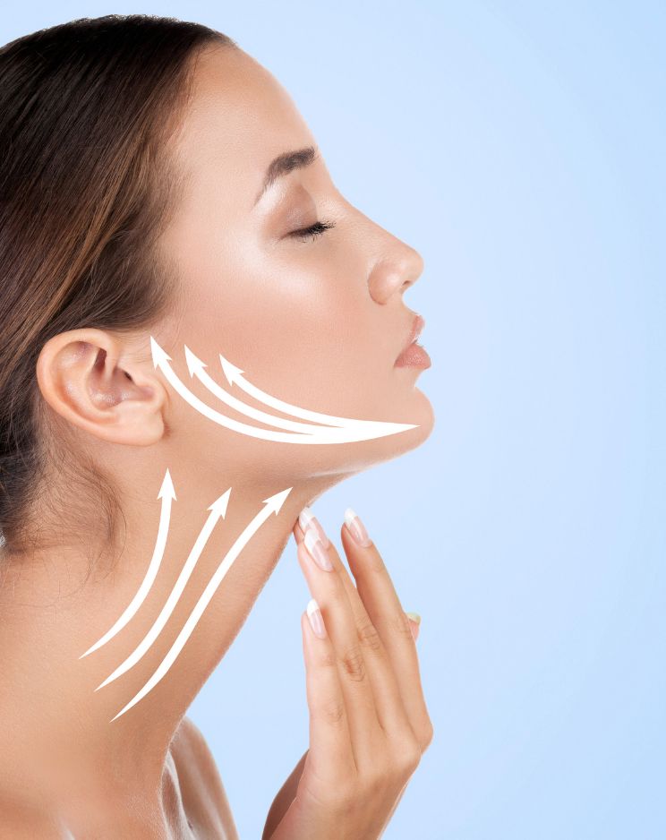 Mini Facelift (thread lift)