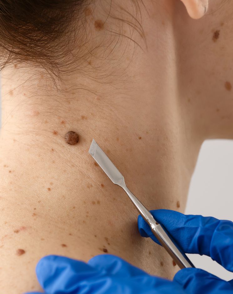 Mole & Skintag Removal