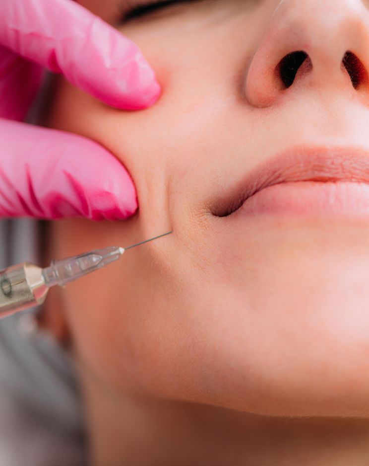 Nasolabial Folds Treatment