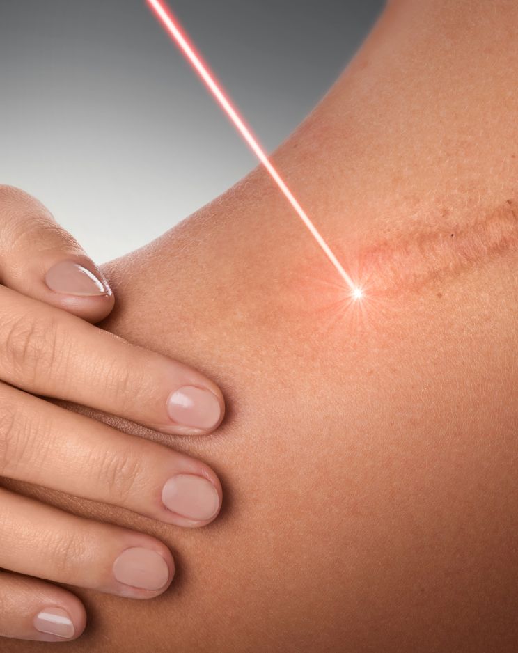 Scar Removal