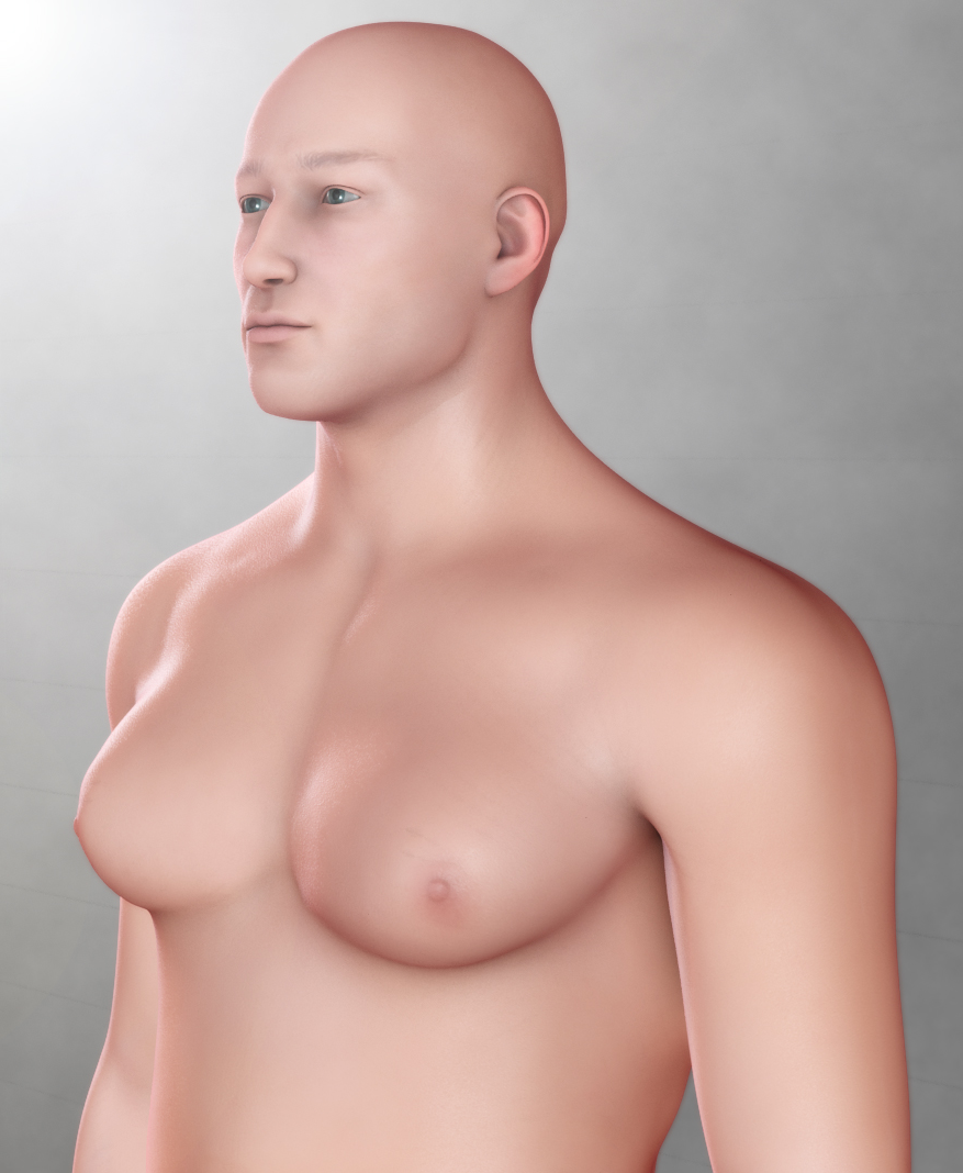 Gynecomastia