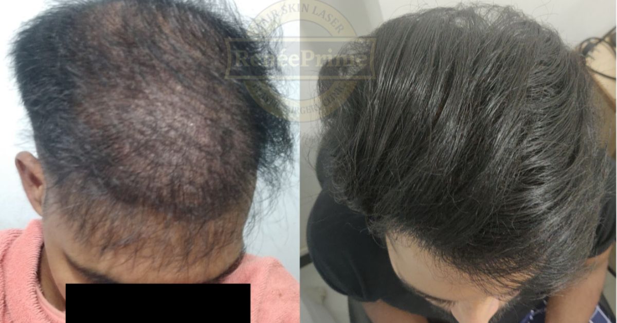 Bio fibre Hair Transplant