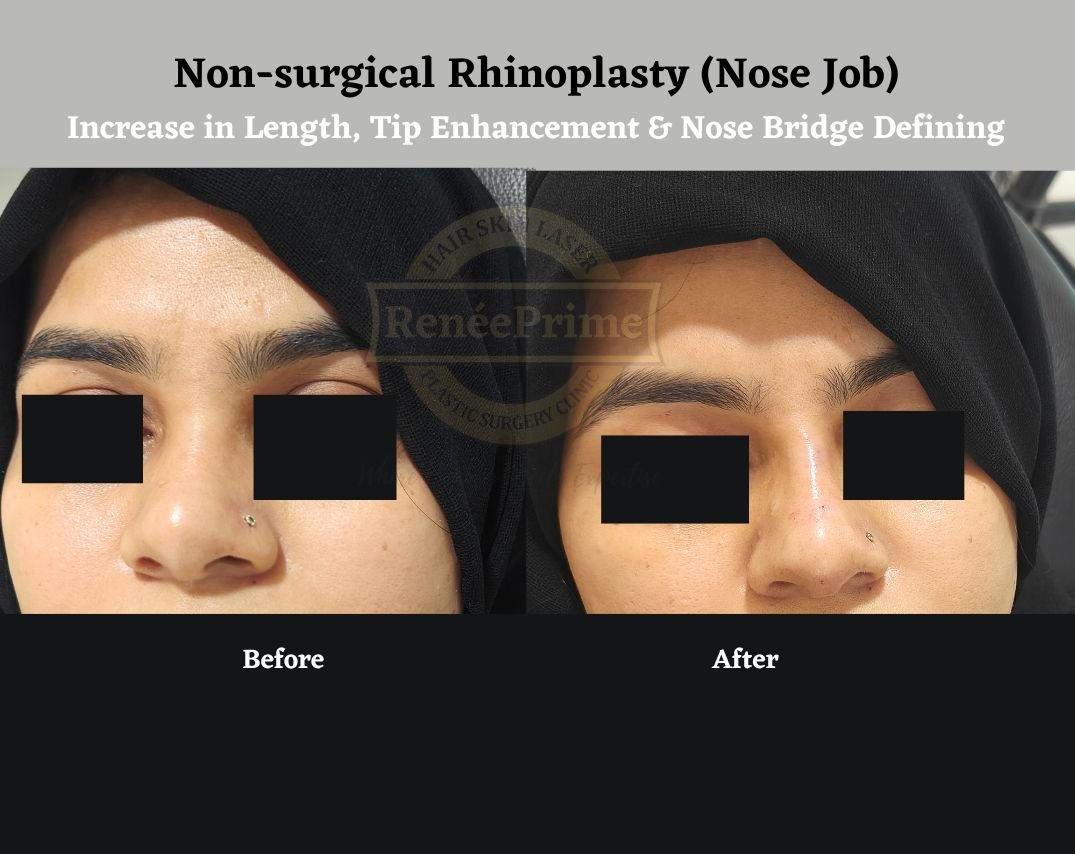 Nasal Fillers in Mumbai