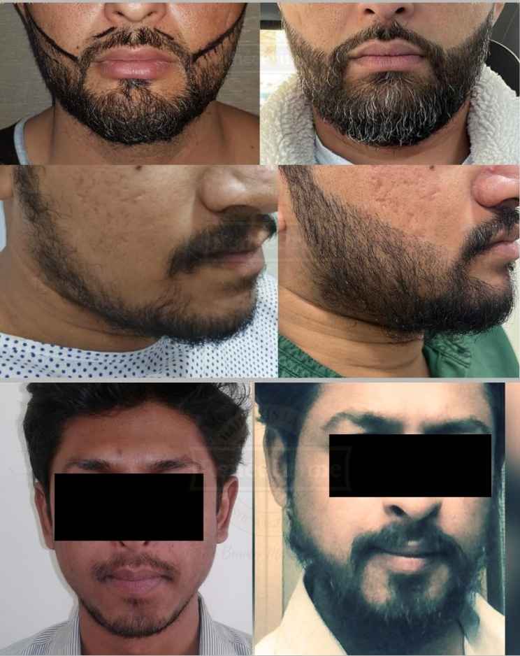 Beard Transplant in mumbai
