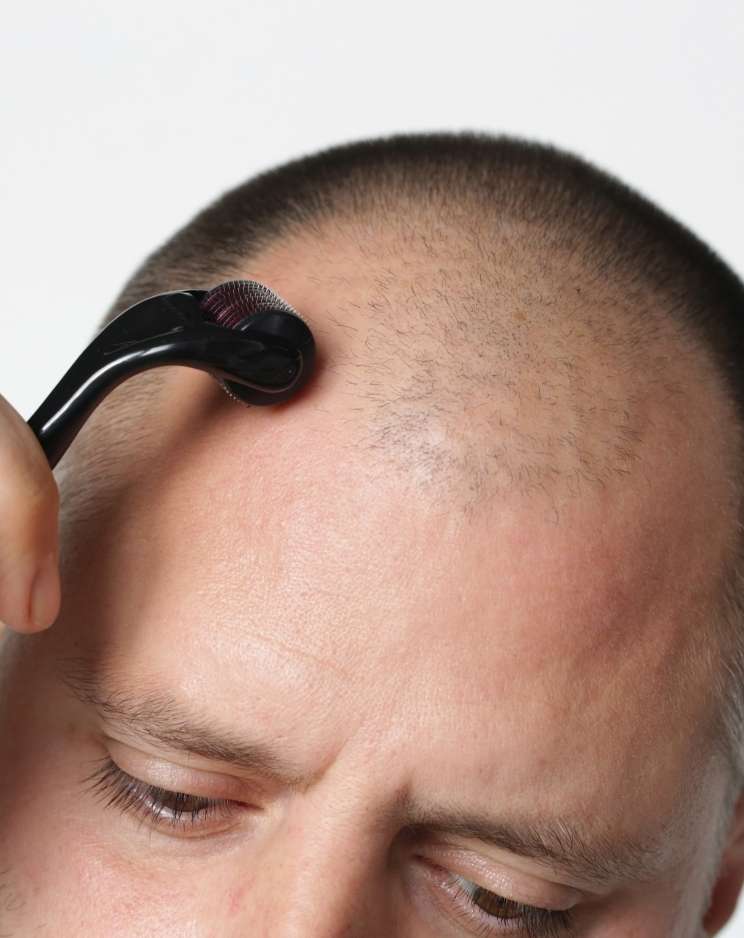 Why Choose Dermaroller for Hair Loss