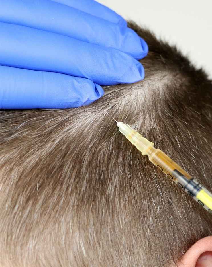 Why Choose Mesotherapy for Hair Loss