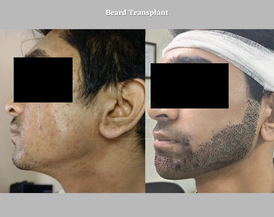 beard hair transplant cost