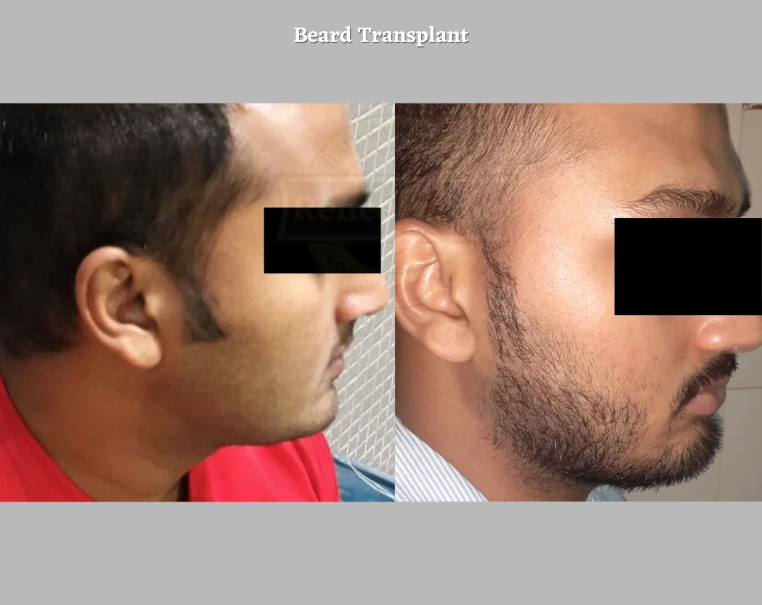 beard transplant cost