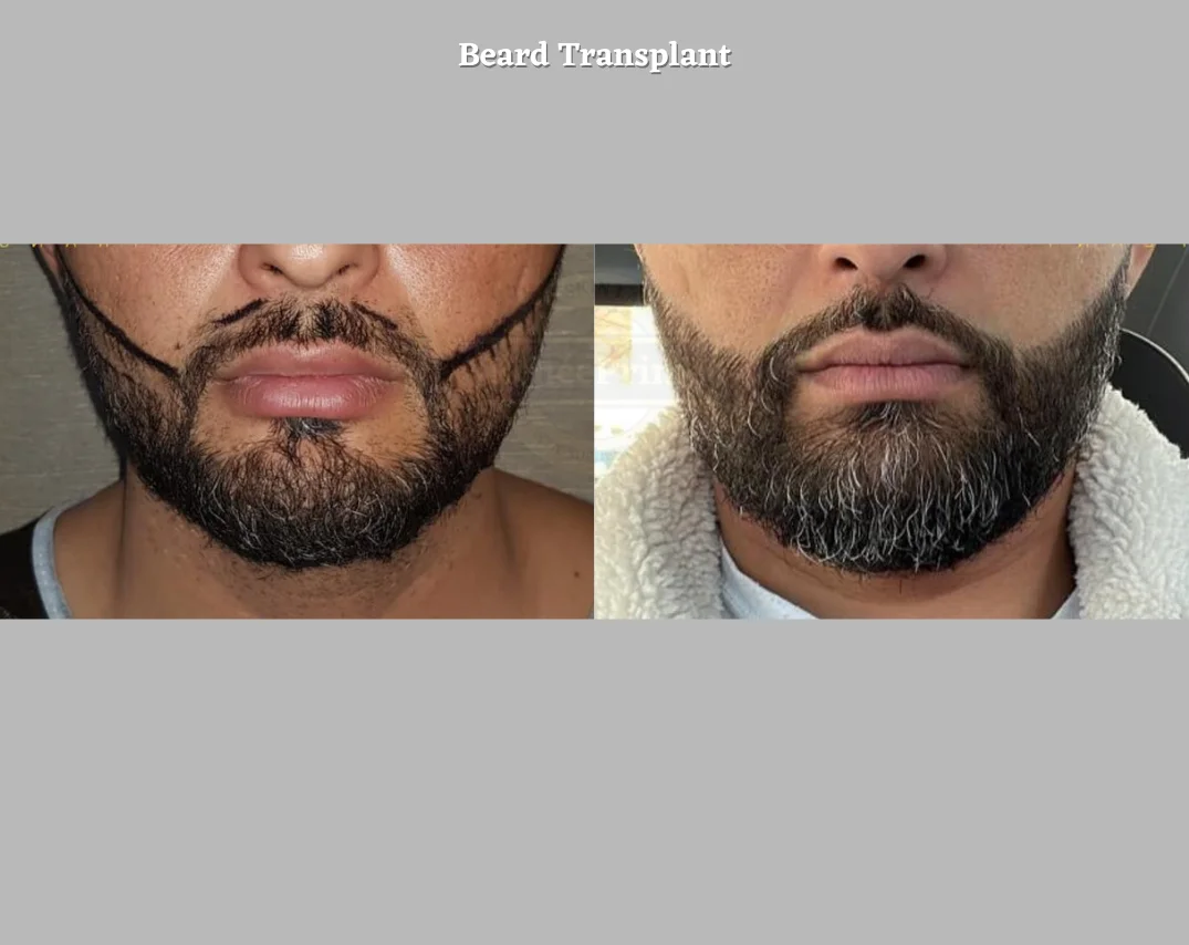 beard transplant