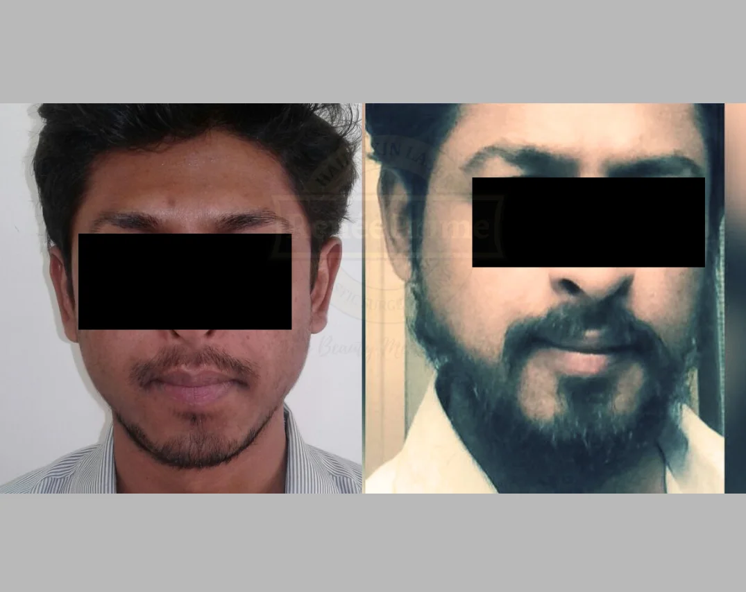 brow transplant cost