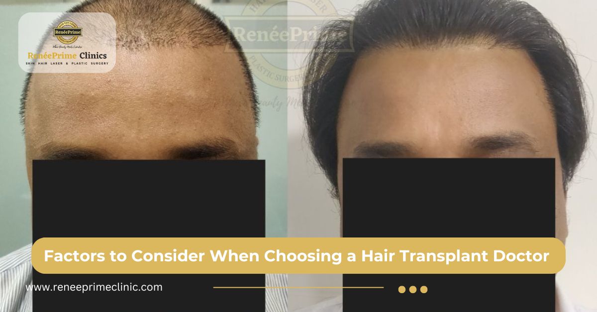 Factors to Consider When Choosing a Hair Transplant Doctor