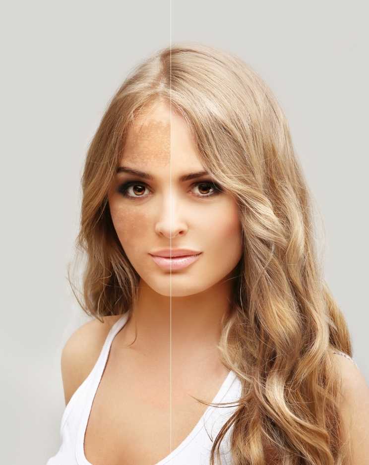 Why Choose Professional Pigmentation Treatment