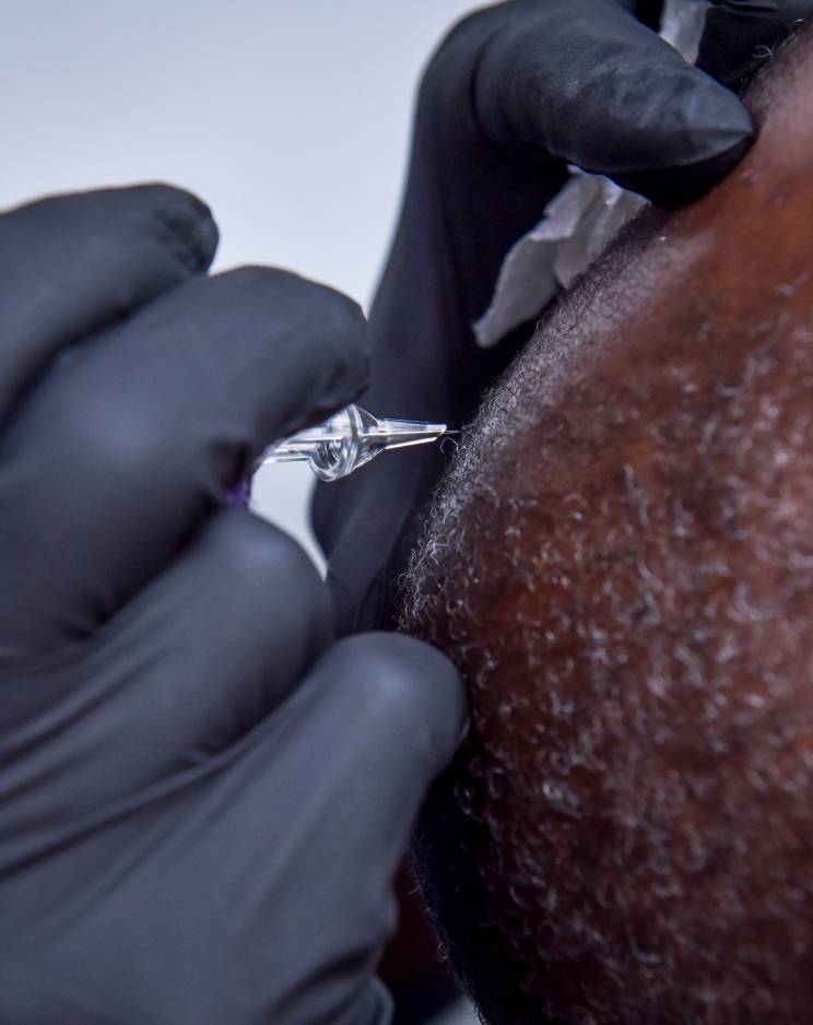 Why Choose Scalp Micropigmentation at Renee Prime Clinic in mumbai