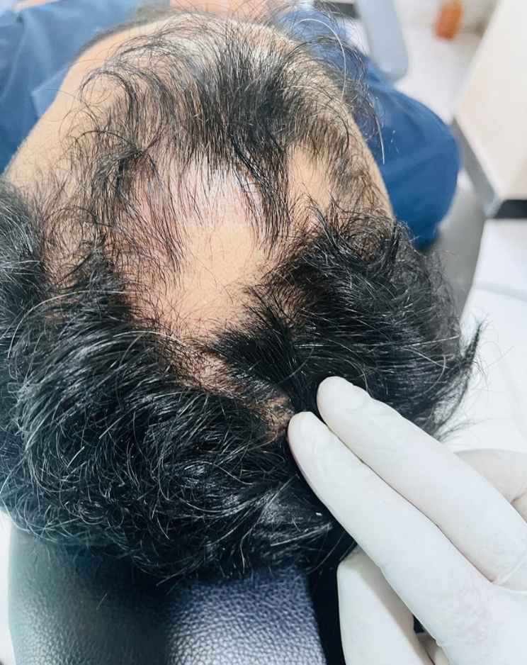 Choose RenéePrime Clinic images Hairline