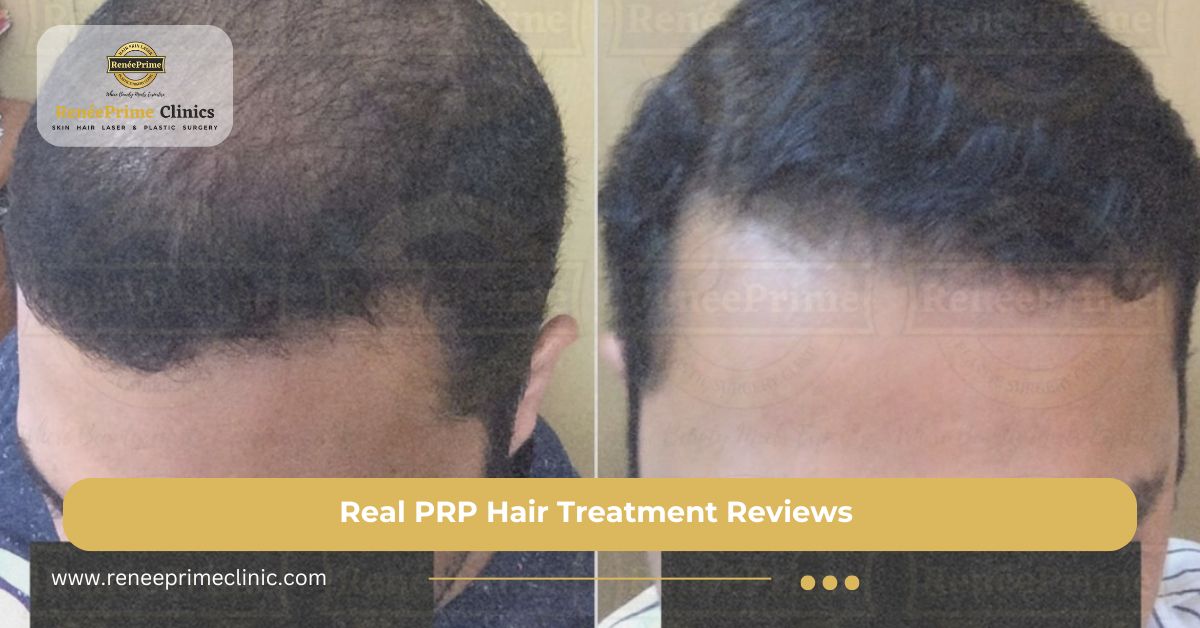 Real PRP Hair Treatment Reviews