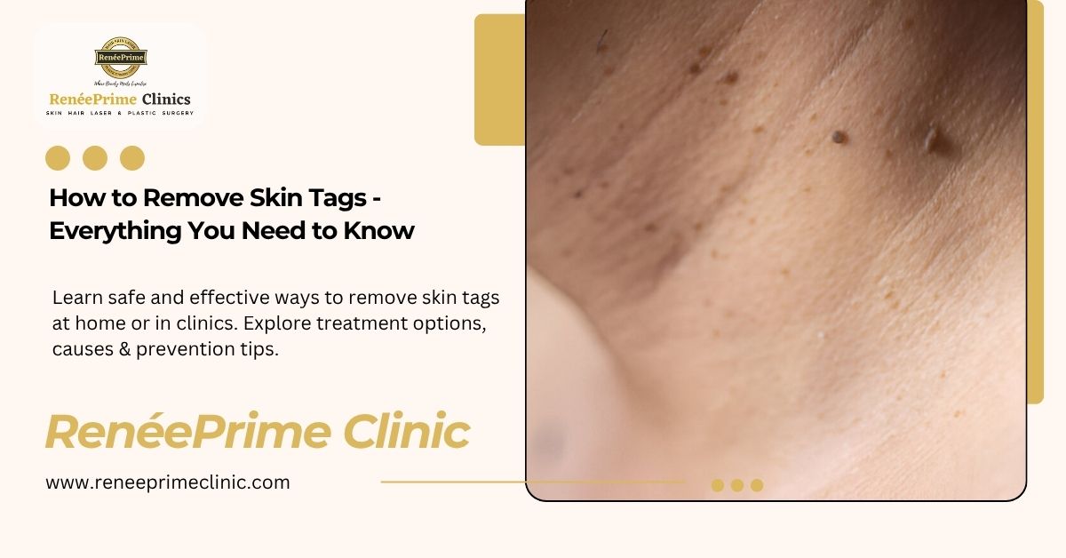 How to Remove Skin Tags – Everything You Need to Know