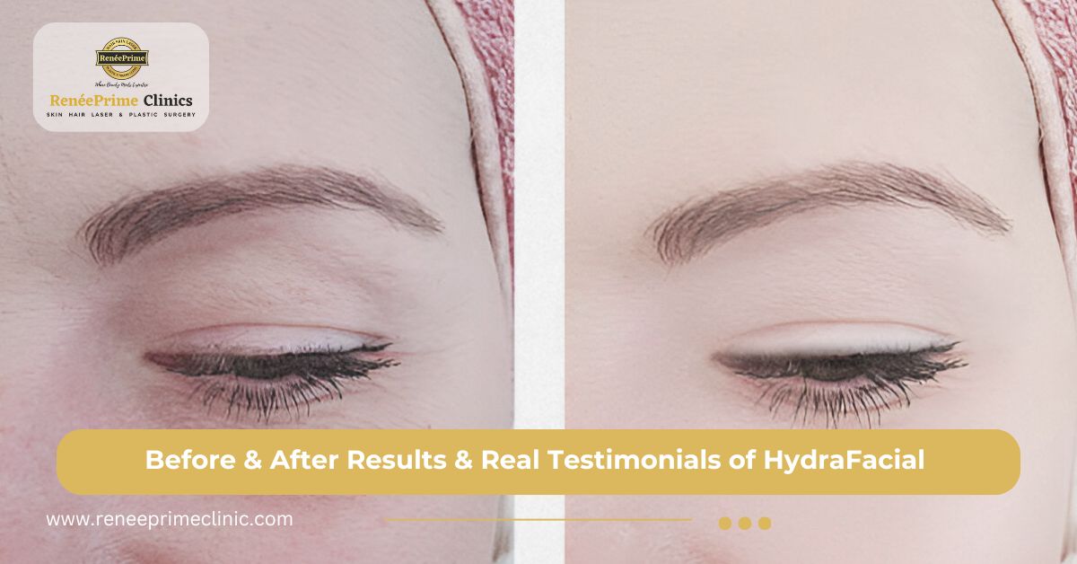Before & After Results & Real Testimonials of HydraFacial