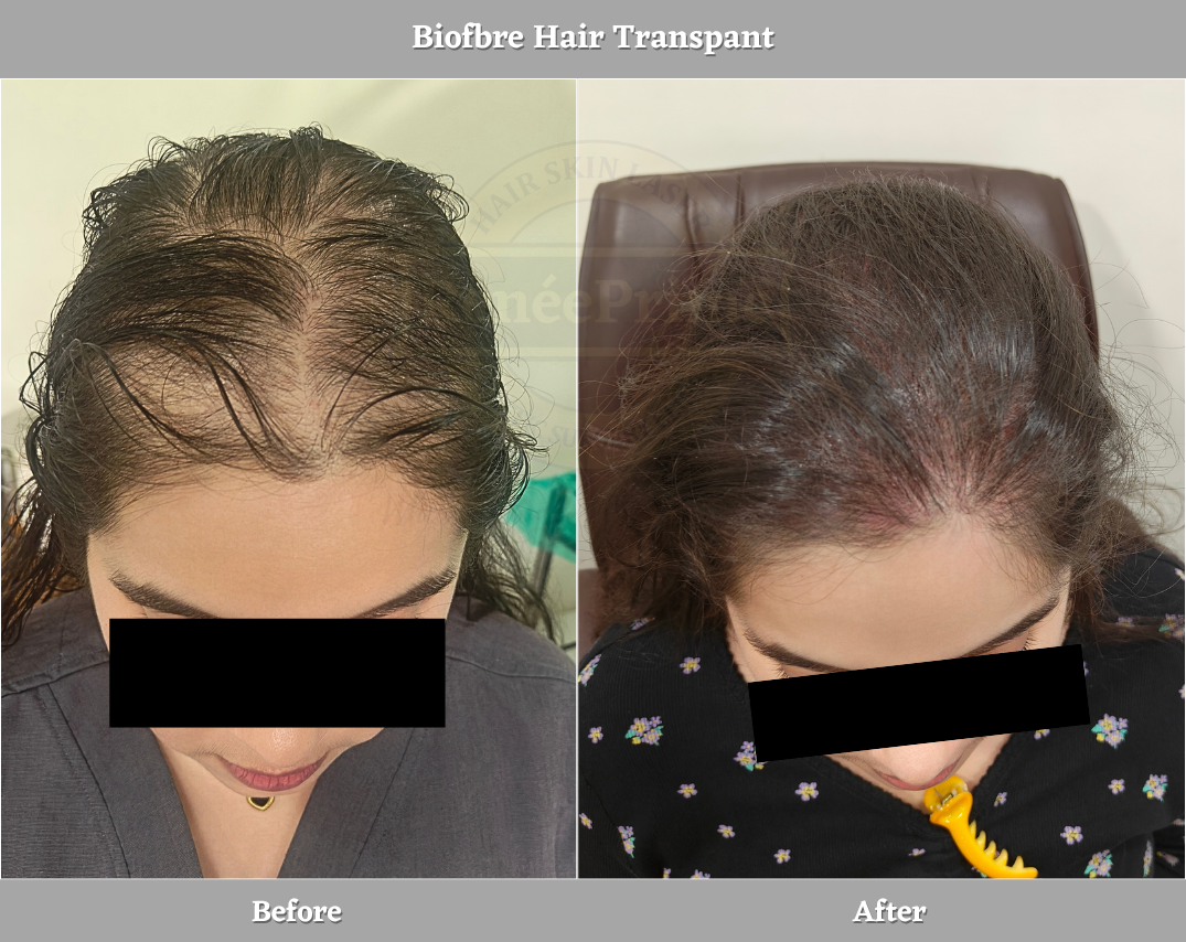 biofibre hair transplant in ladies Before and after