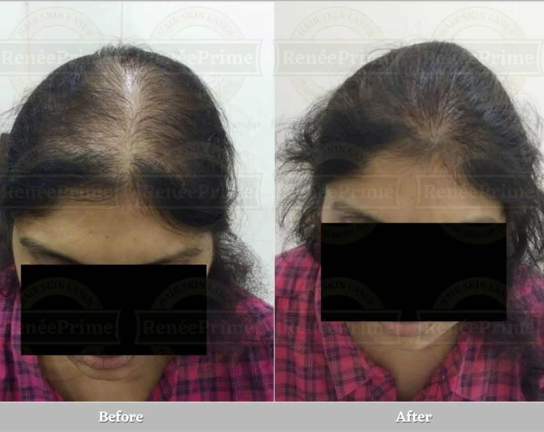 biofiber hair tranplant story