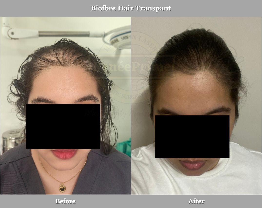 woman biofiber hair transplant