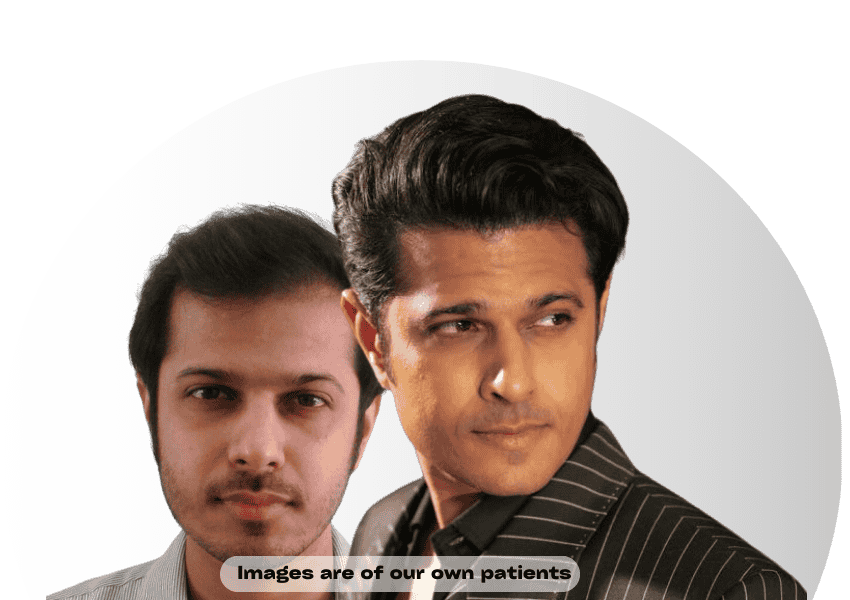 Celebrity Hair Transplant in mumbai india