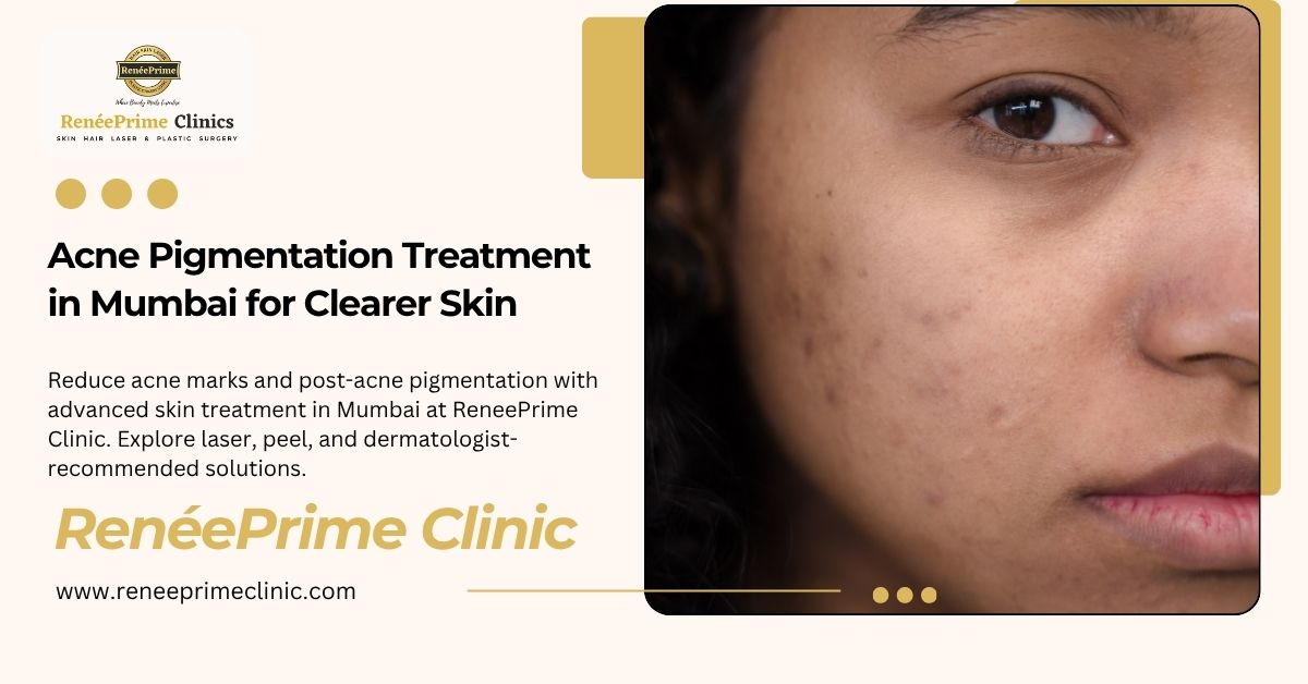 Acne Pigmentation Treatment in Mumbai for Clearer Skin
