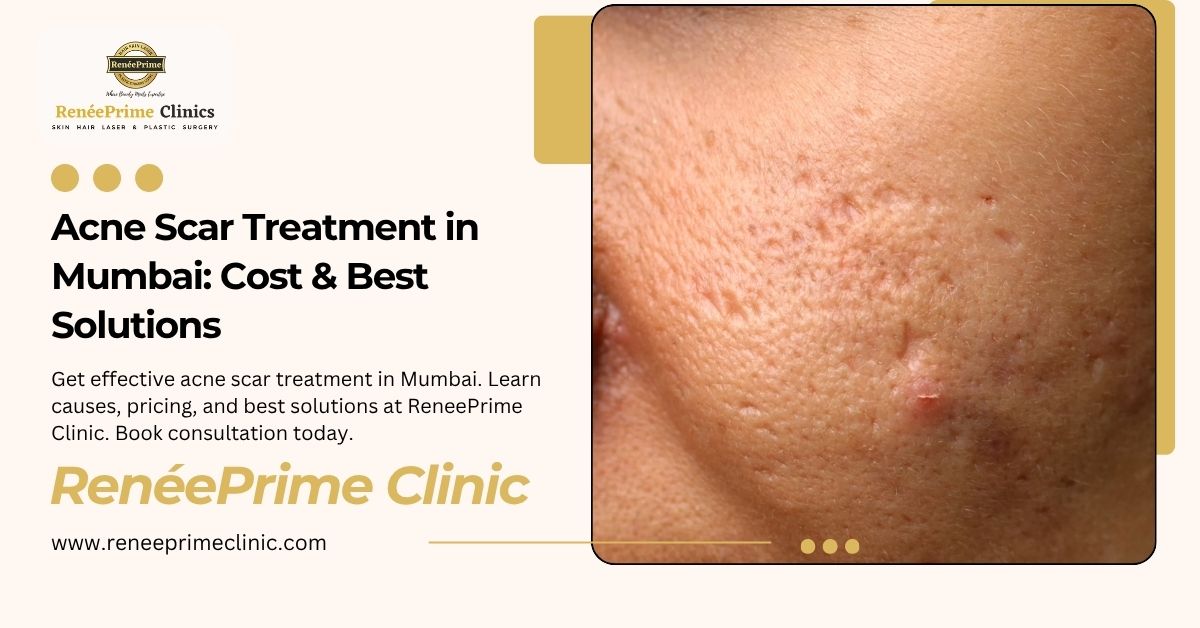 Acne Scar Treatment in Mumbai: Cost & Best Solutions