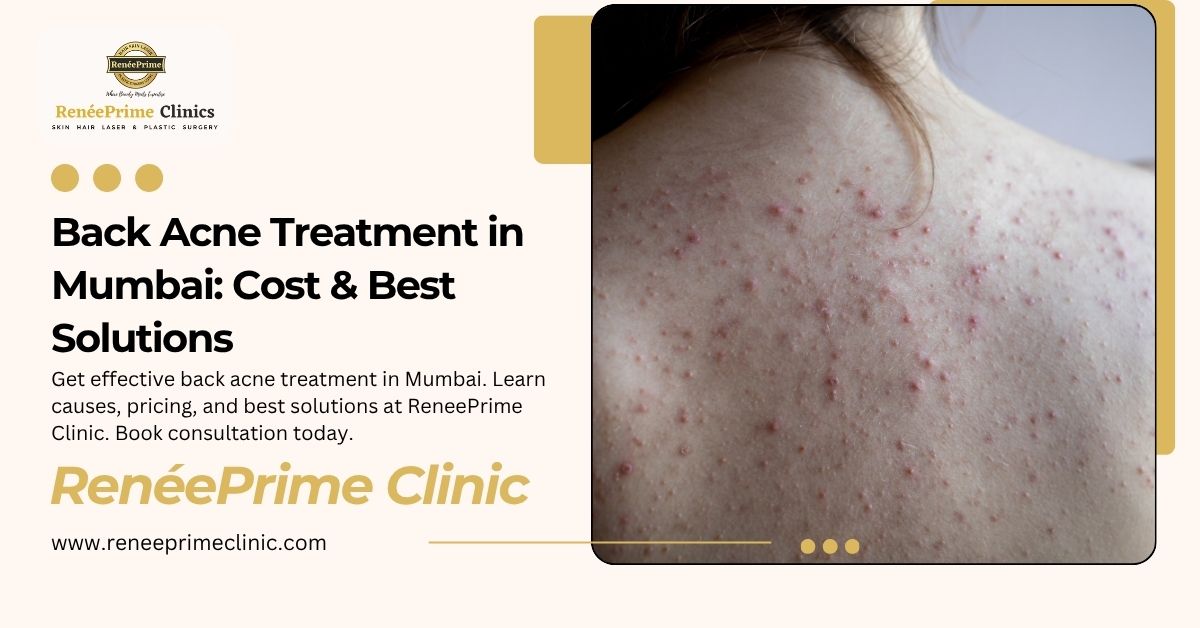 Back Acne Treatment in Mumbai: Cost & Best Solutions