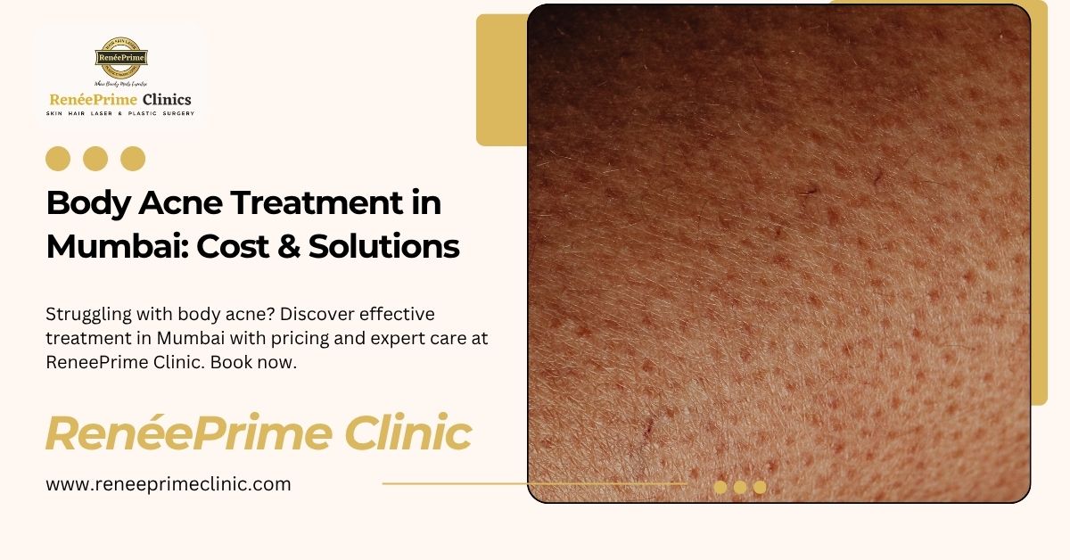 Body Acne Treatment in Mumbai: Cost & Solutions