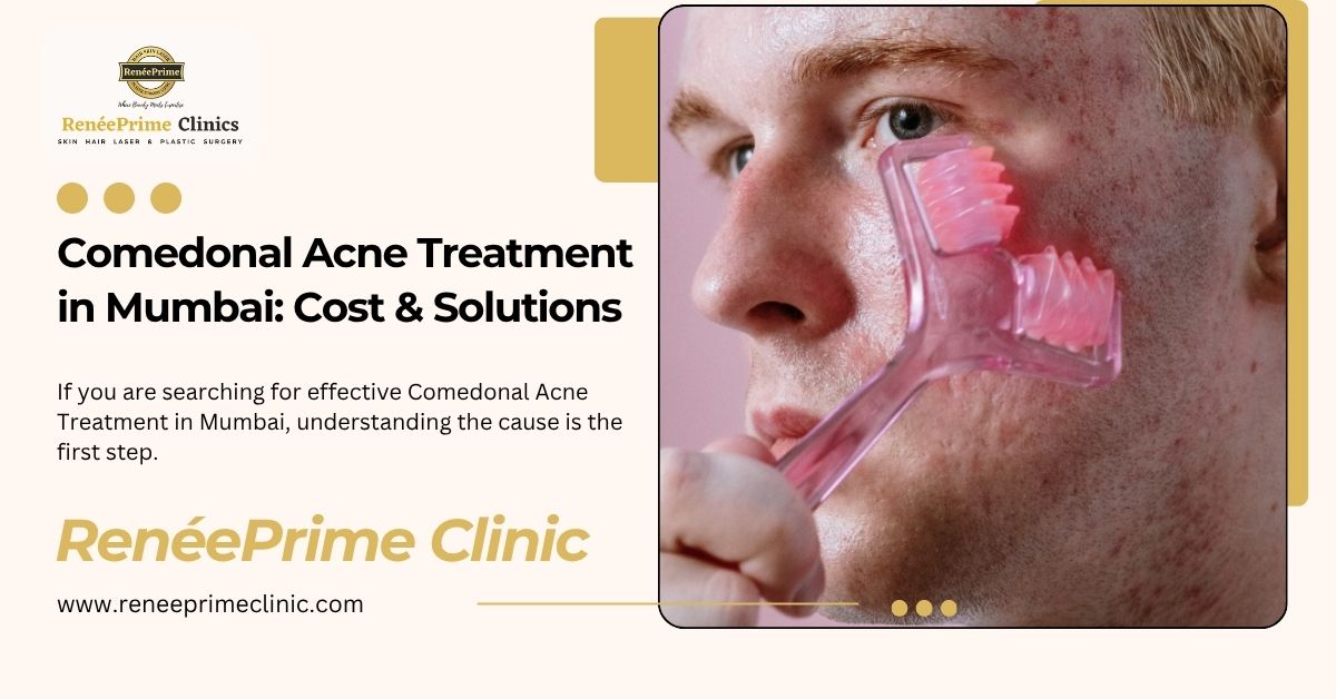 Comedonal Acne Treatment in Mumbai: Cost & Solutions