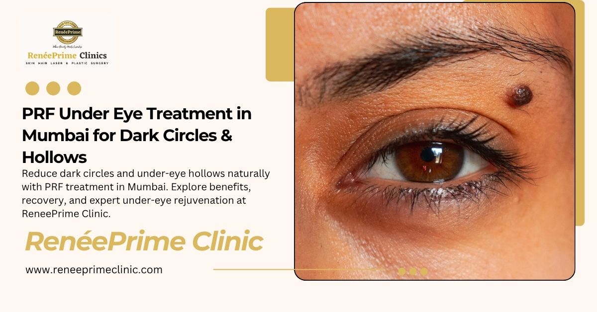 PRF Under Eye Treatment in Mumbai for Dark Circles & Hollows