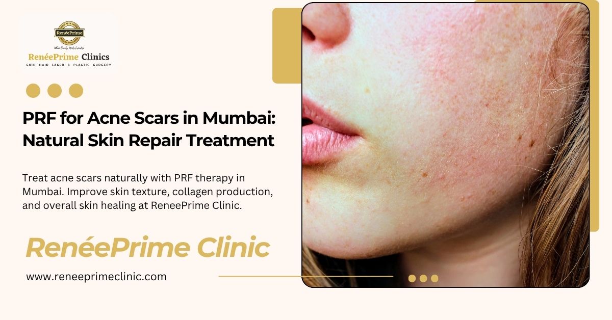 PRF for Acne Scars in Mumbai Natural Skin Repair Treatment