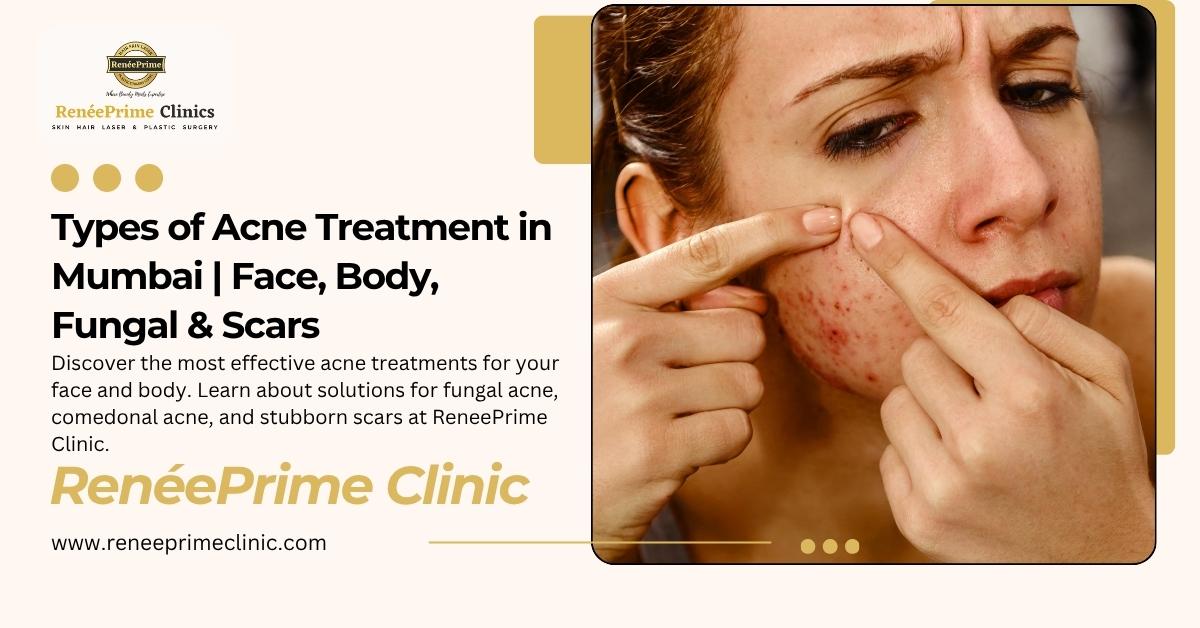 Different Types of Acne Treatment: Face, Body, Fungal & Scar Solutions Explained