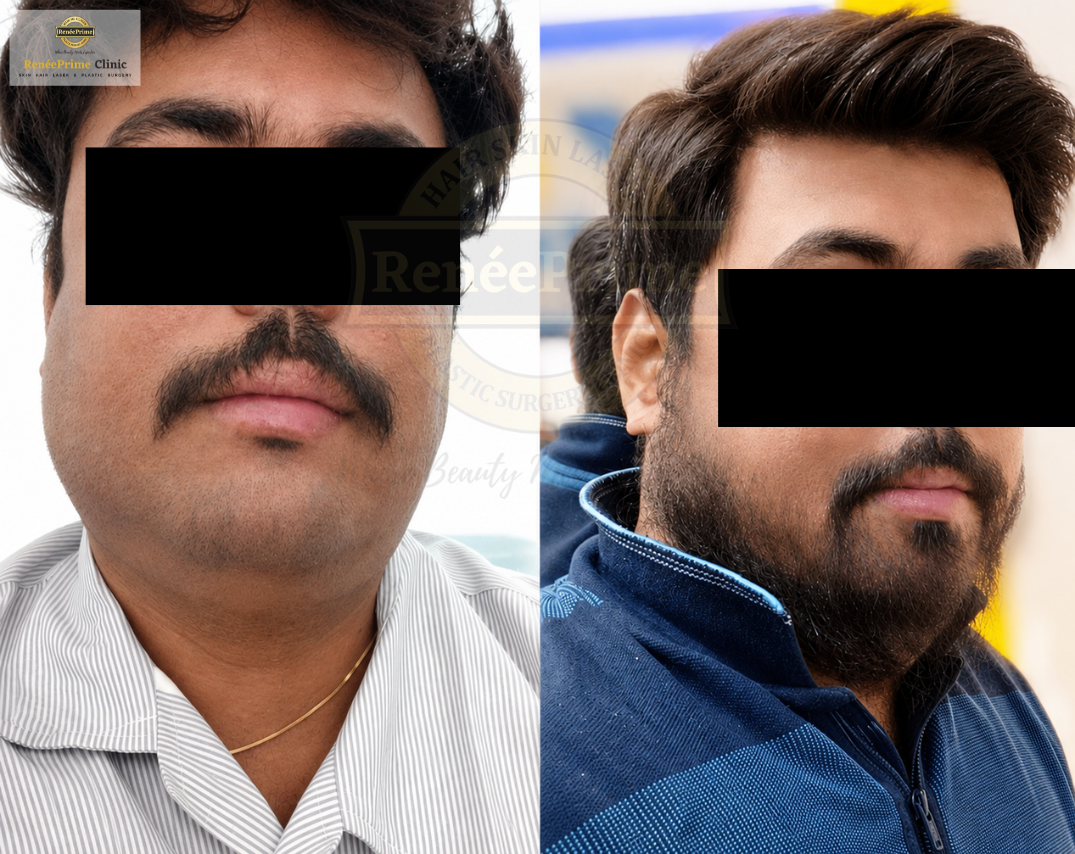 Beard Transplant result before and after
