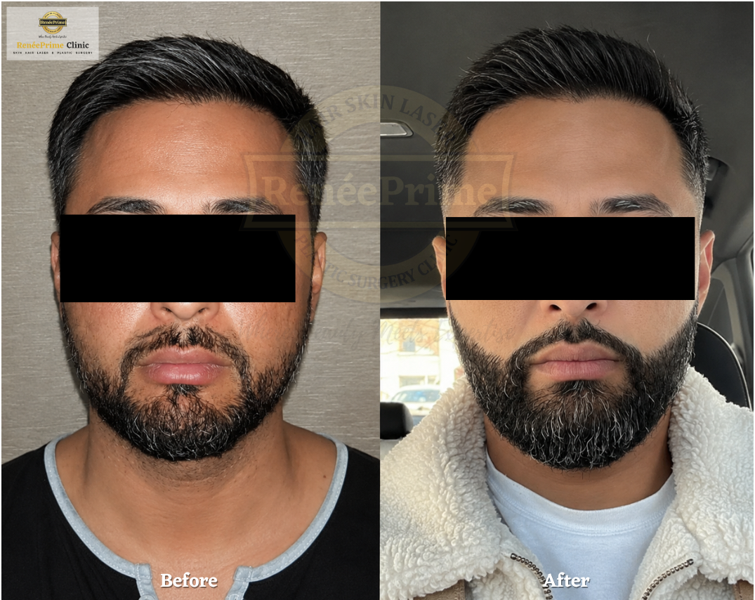 beard transplant in mumbai before and after