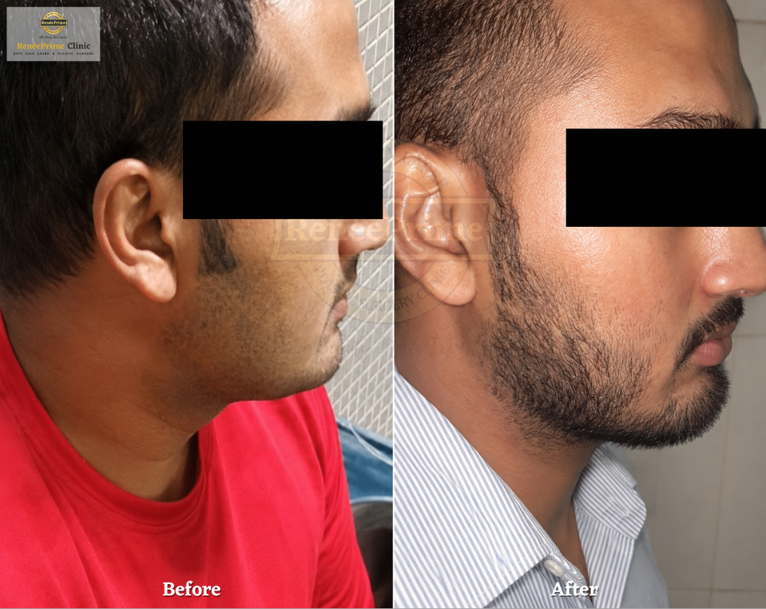 Beard transplant in mumbai before and after