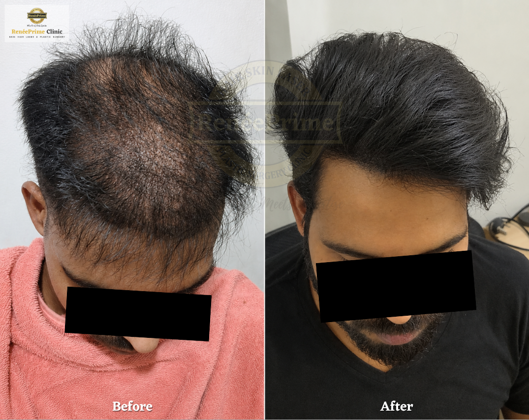 biofibre Hair transplant in Mumbai before and after