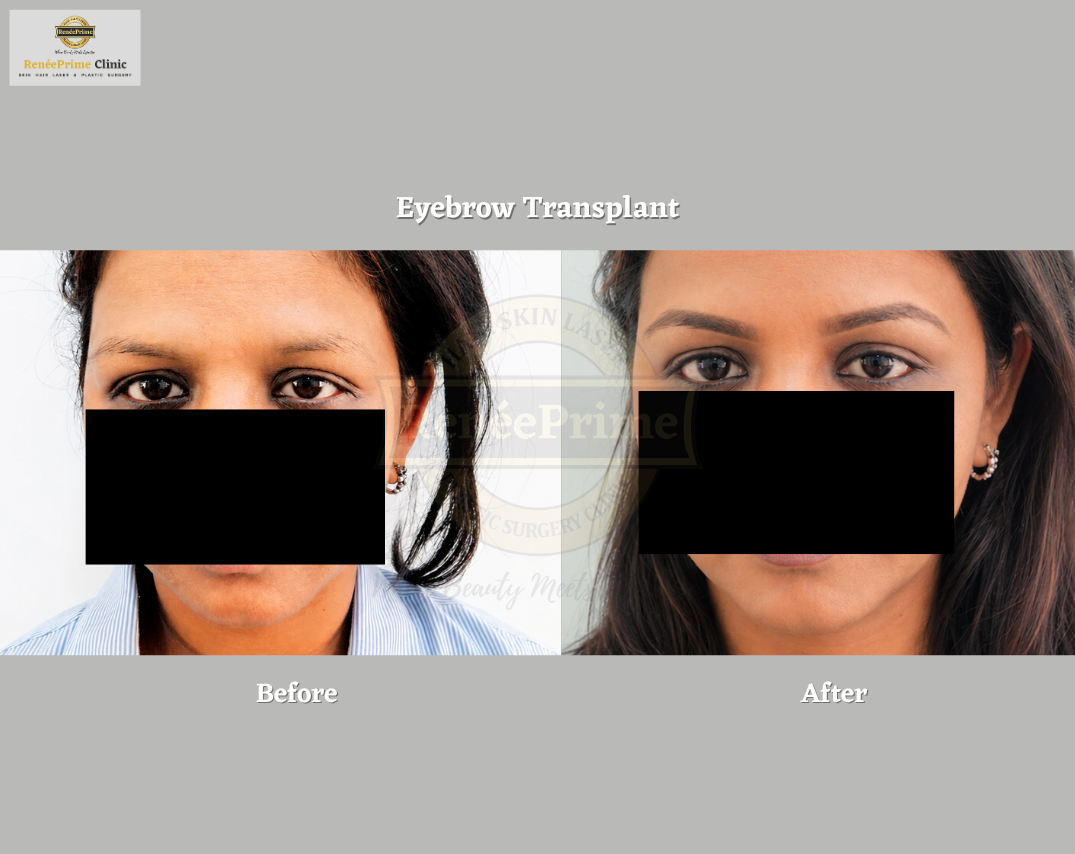EYEBROW TRANSPLANT in mumbai before and after