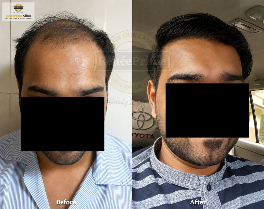 Hair transplant in Mumbai before and after