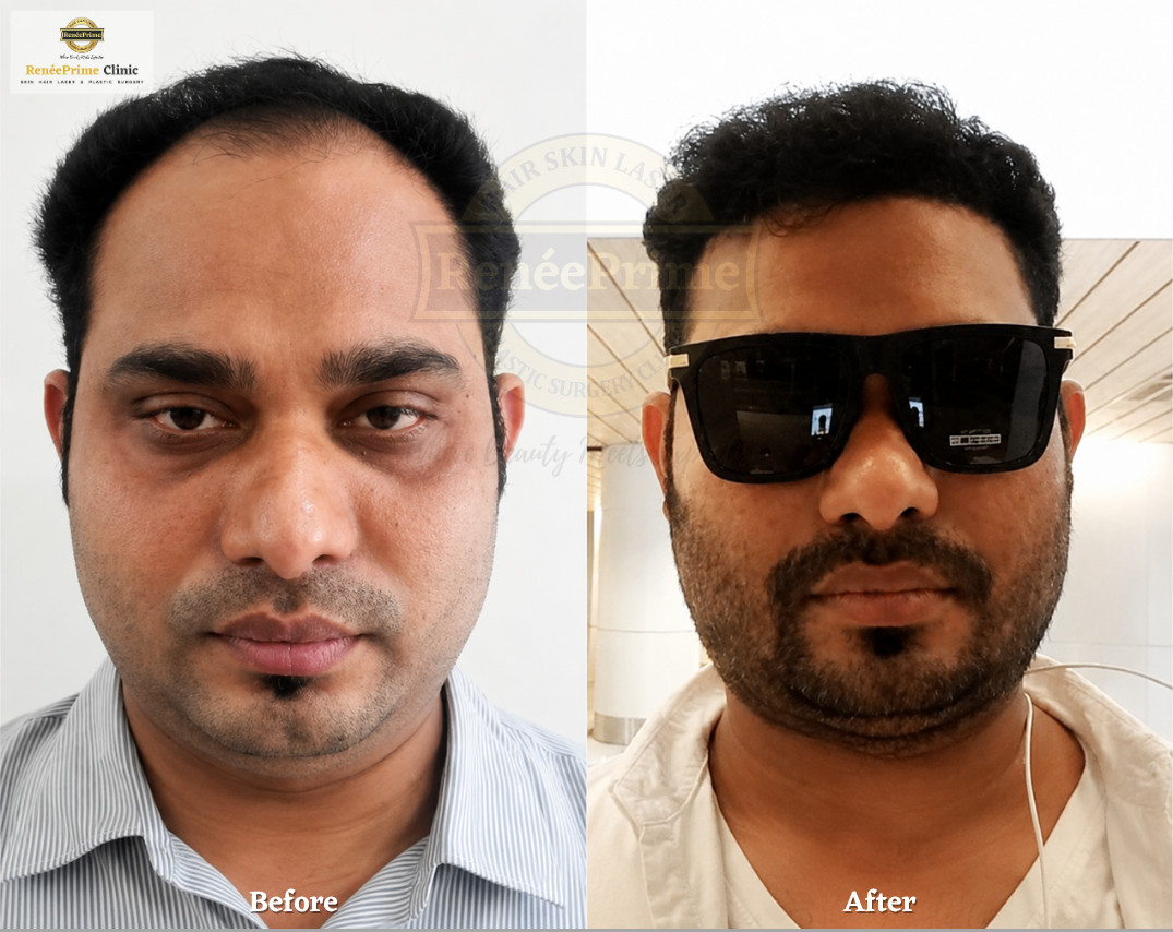 hairline hair transplant
