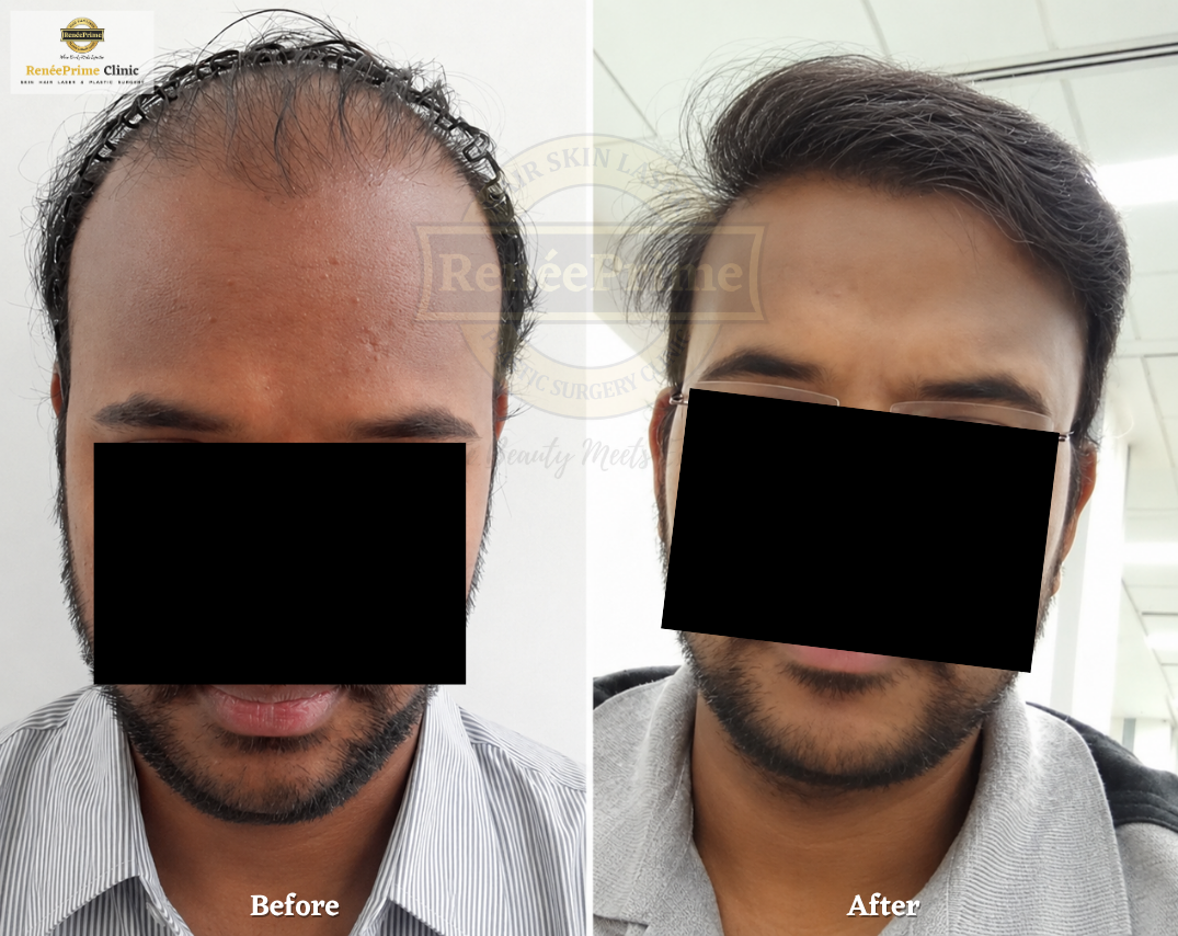 failed hair transplant correction in mumbai
